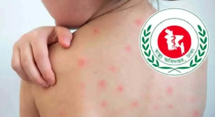 হামের উপসর্গে আরও ৭ মৃত্যু