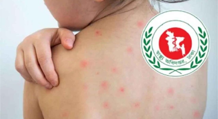 হাম ও উপসর্গে আক্রান্ত ১১৫৪, মৃত্যু একজনের