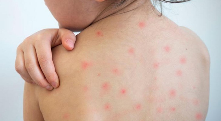 হামের উপসর্গে এক দিনে আরও ১০ মৃত্যু, আক্রান্ত ৫৪