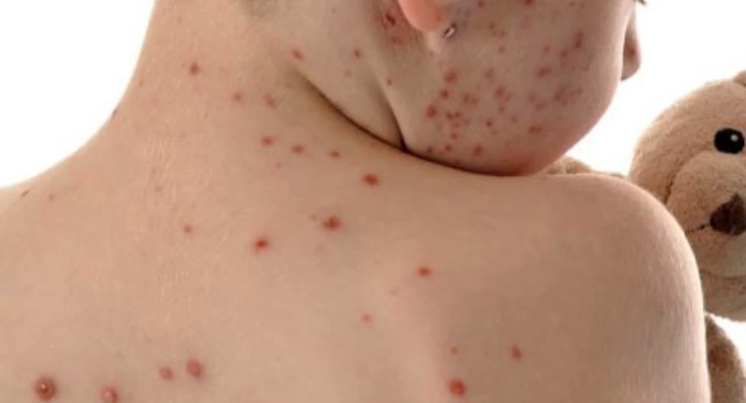 হাম : আরও ৩ শিশুর মৃত্যু